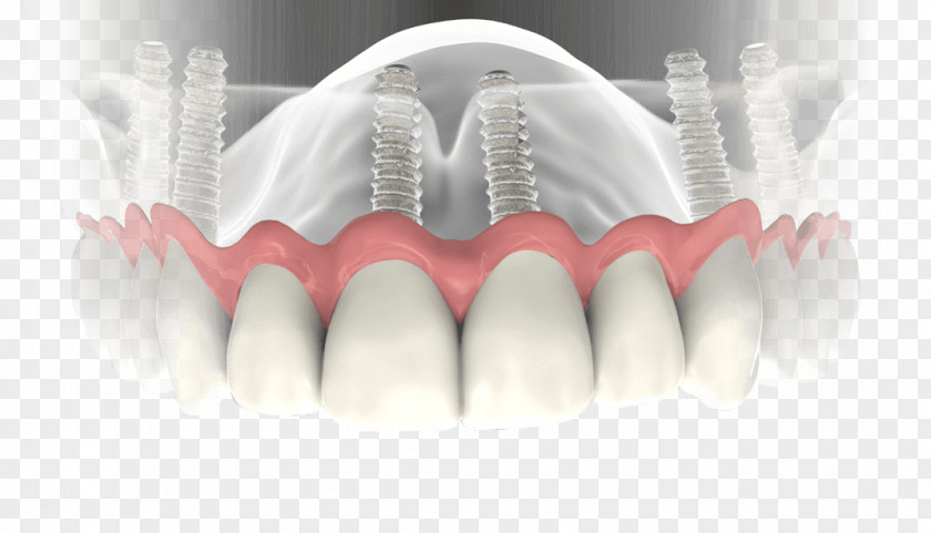 Dental Implants Implant Dentistry Dentures PNG