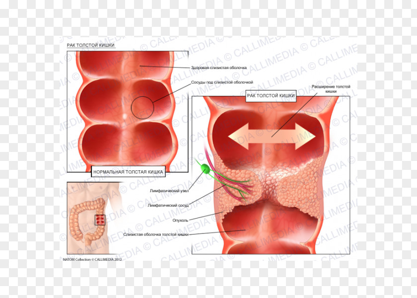 Colon Cancer Illustration Anatomique Ductal Carcinoma In Situ Oncology PNG