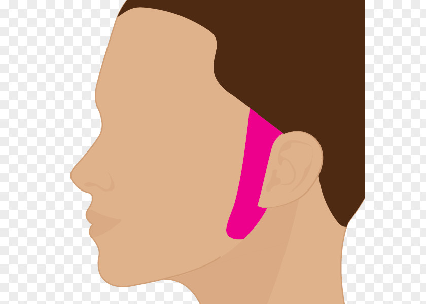 Depilacion Laser Hair Removal Sideburns Chin Cheek PNG