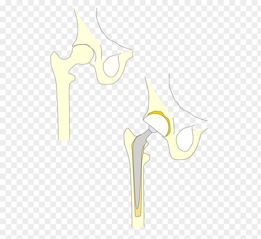 These Hip Replacement Prosthesis Joint Pelvis PNG
