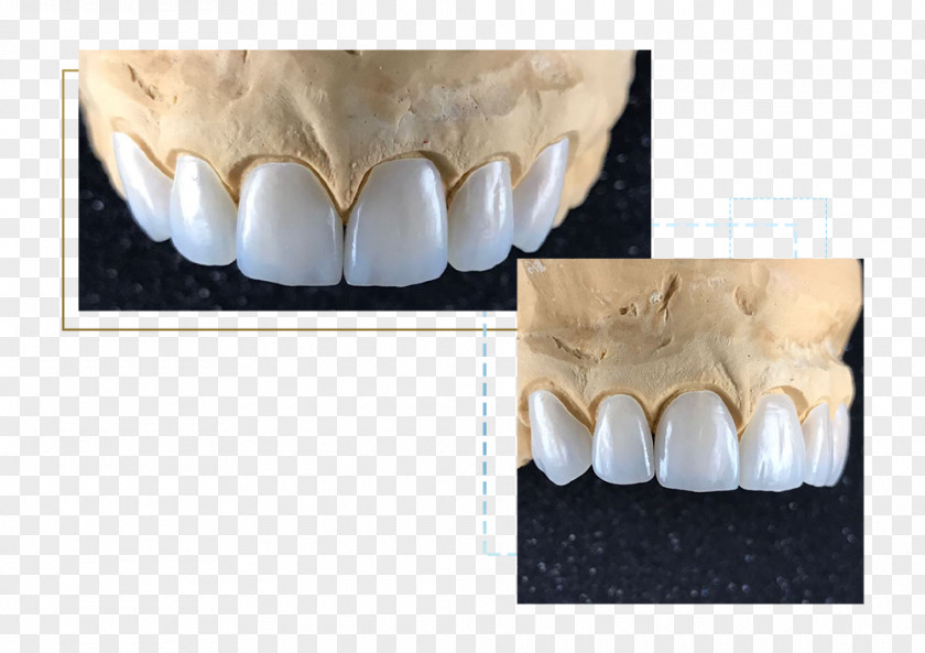 Veneers Veneer Porcelain Aesthetics Human Tooth PNG