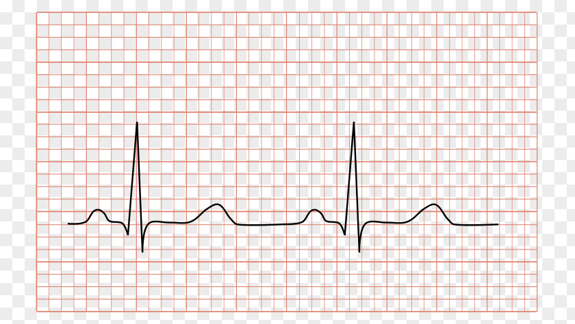 Heart Dynamic Electrocardiography Sinus Rhythm QRS Complex Cardiology PNG