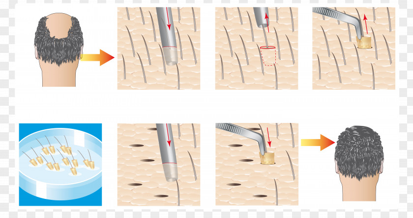 Hair Transplantation Loss Microinjerto Capilar Follicular Unit Extraction PNG