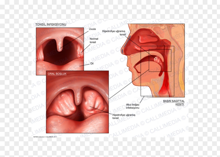Tonsil Tonsillitis Pharyngitis Otorhinolaryngology Adenoid PNG