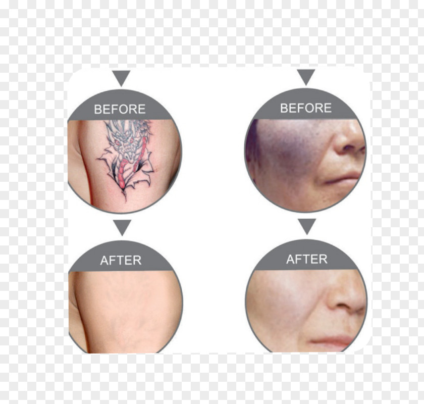 Nd:YAG Laser Tattoo Removal Photorejuvenation Hair PNG