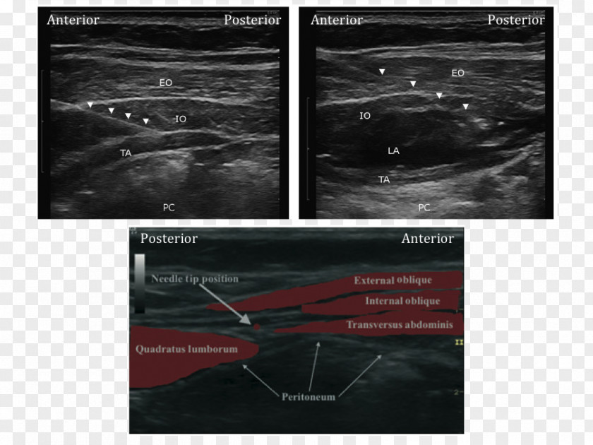 Oblique Line Quadratus Lumborum Muscle Lumbar Triangle Ultrasonography Transverse Abdominal Ultrasound PNG