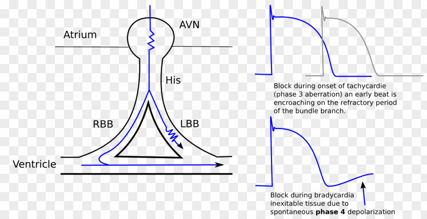 Left Bundle Branch Block Right Branches Electrical Conduction System Of The Heart PNG