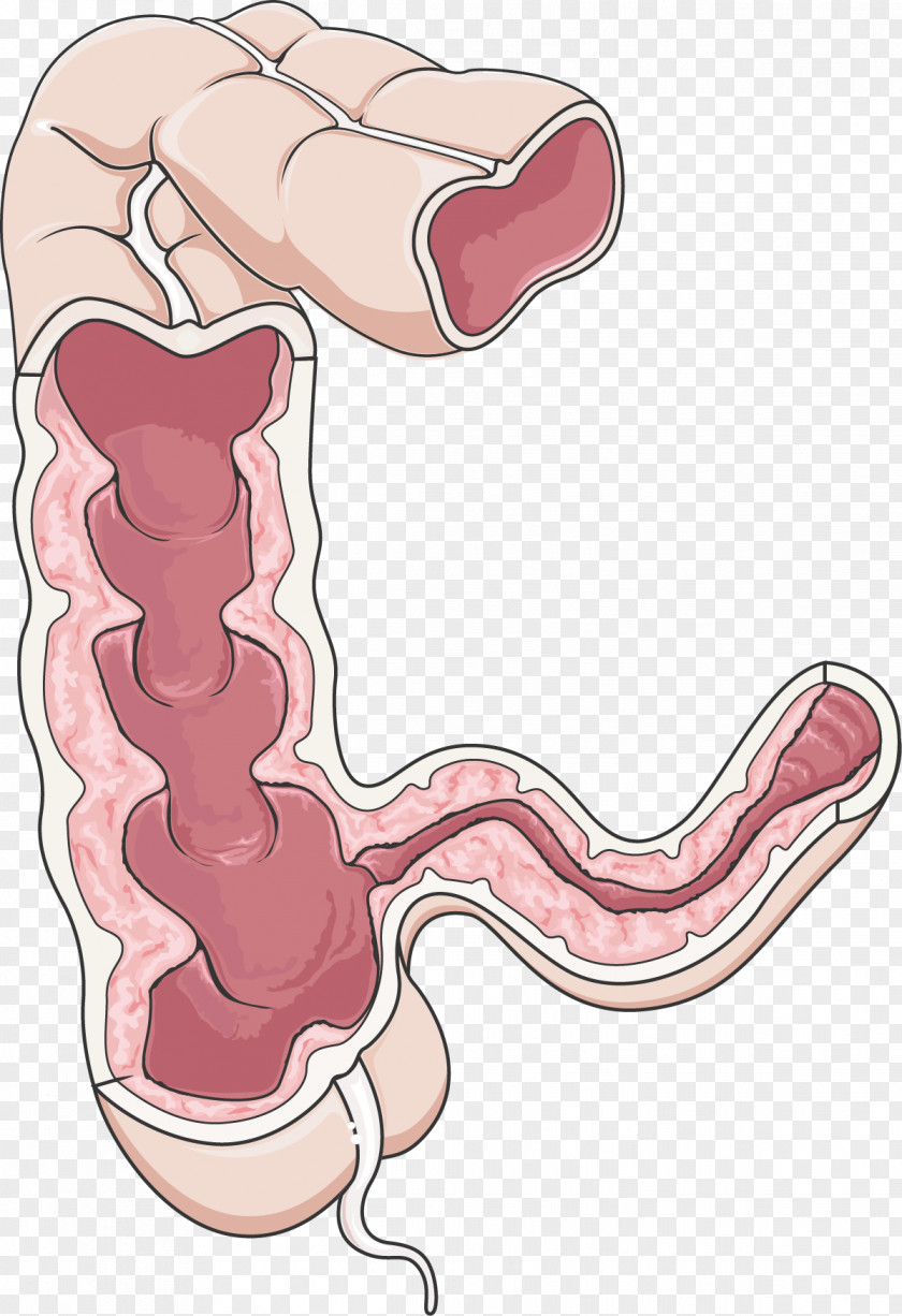 Crohn's Disease Large Intestine Gastrointestinal Tract Inflammatory Bowel PNG