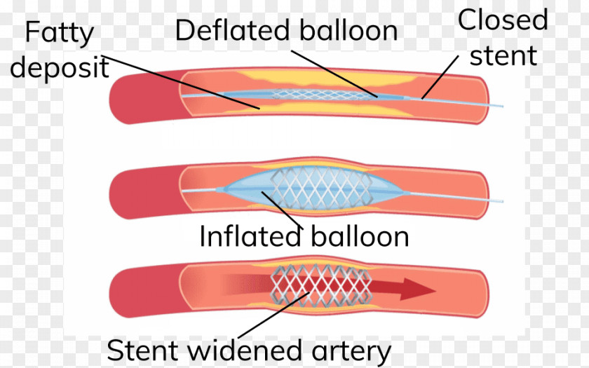 Coronary Artery Disease Angioplasty Heart Arteriosclerosis Stenting PNG