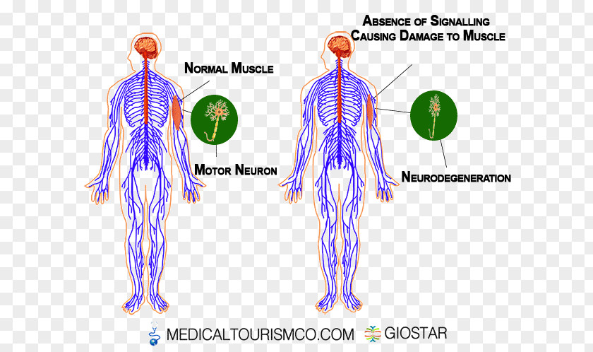 Symptoms Slurred Speech Shoulder Human Behavior Blood Vessel Muscle PNG