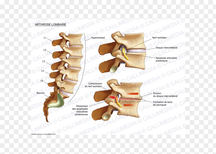 Box Illustration Joint Cervical Osteoarthritis Lumbar Vertebrae Process PNG