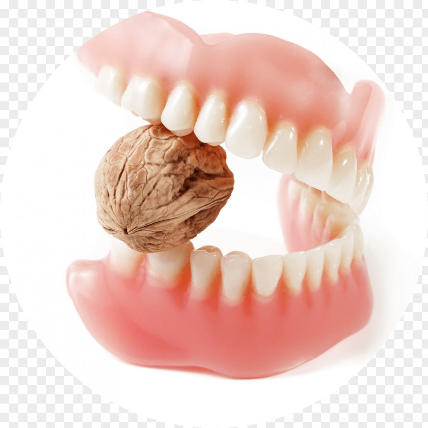 Dental Restoration Prosthesis Tooth Bridge Royalty-free Dentures PNG