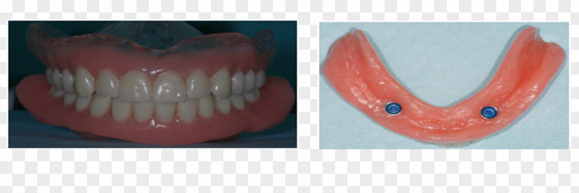 Dental Surgery Tooth Dentures PNG