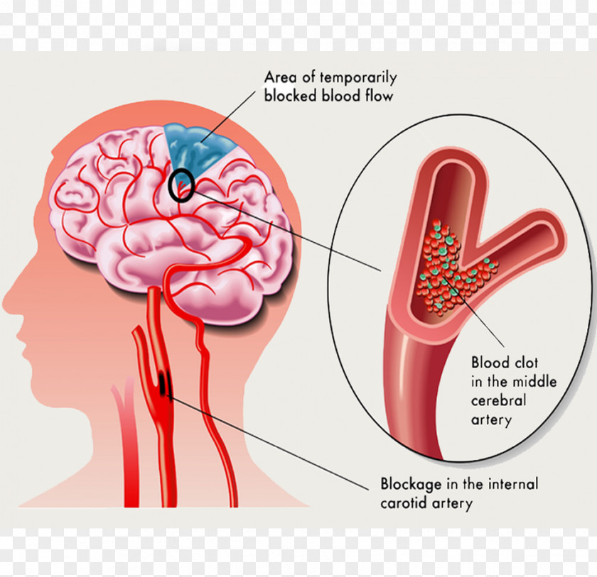 Brain Transient Ischemic Attack Stroke Ischemia Symptom PNG