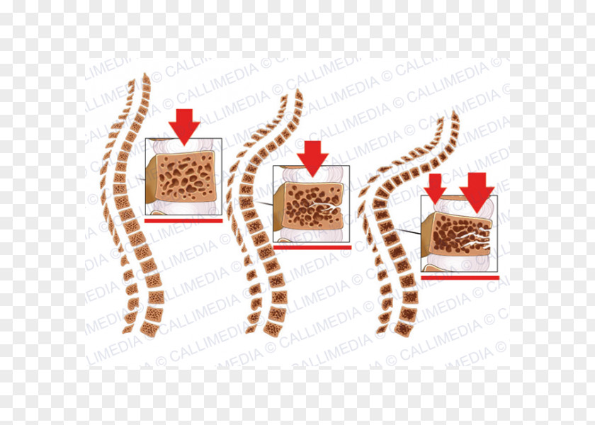 Giraffe Osteoporosis Bone Fracture Vertebral Column Compression PNG