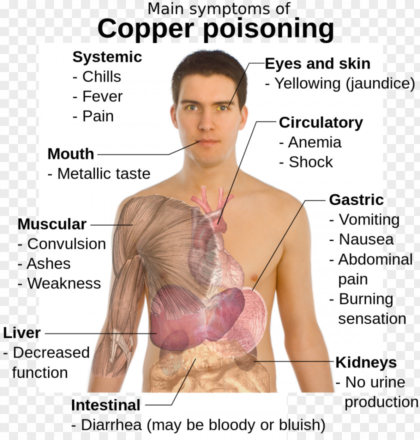 Iron Deficiency Anemia Copper Toxicity Poison Disease Symptom PNG