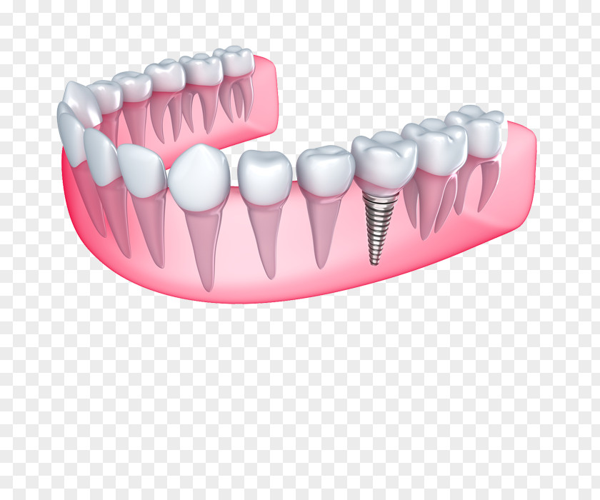 Bridge Dental Implant Cosmetic Dentistry PNG
