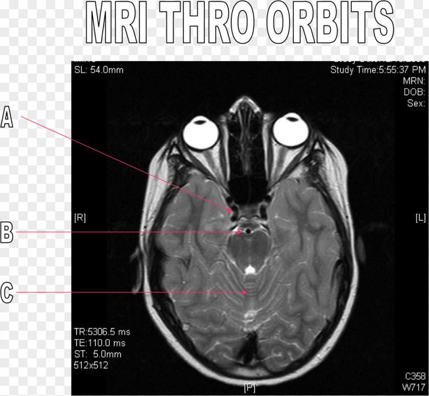 Brain Computed Tomography Radiography PNG