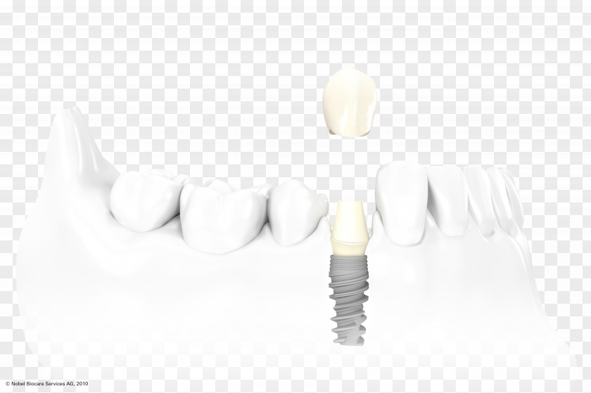 Crown Dental Implant Dentistry Surgery PNG