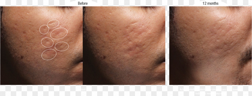 Acne Scars Scar Tretinoin Injectable Filler Dermatology PNG