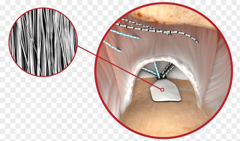 Implant Scaffold Zimmer Biomet Cayenne Medical Inc. Surgery PNG