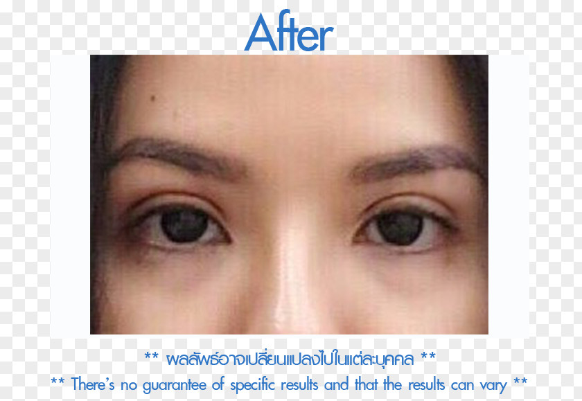 Mupai Follicular Unit Extraction Skin Forehead Eyebrow Cheek PNG