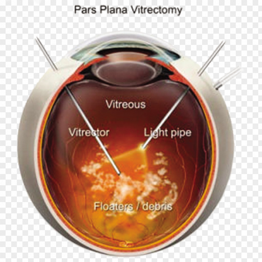 Eye Diabetic Retinopathy Retina Vitreous Body Human Laser PNG