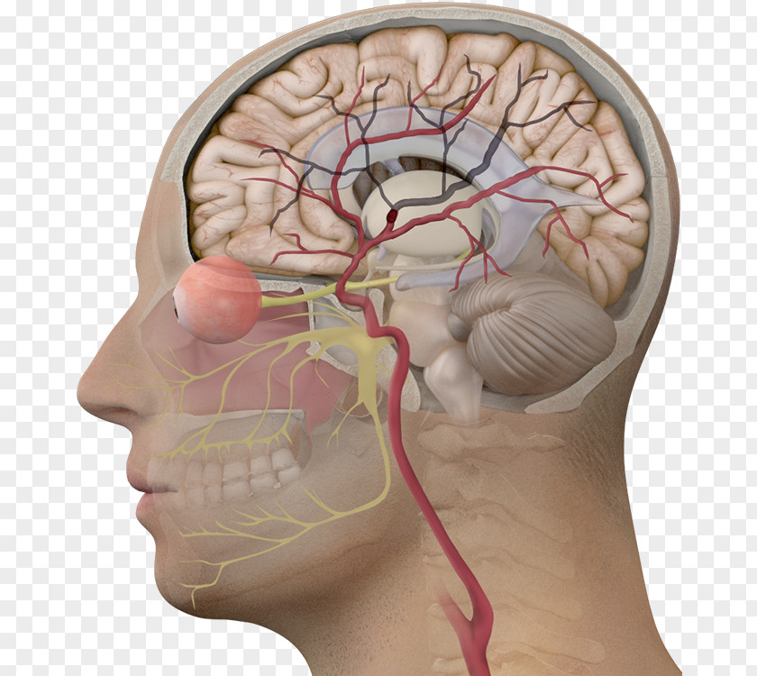 Brain Tumor Hydrocephalus Aneurysm Subarachnoid Hemorrhage PNG