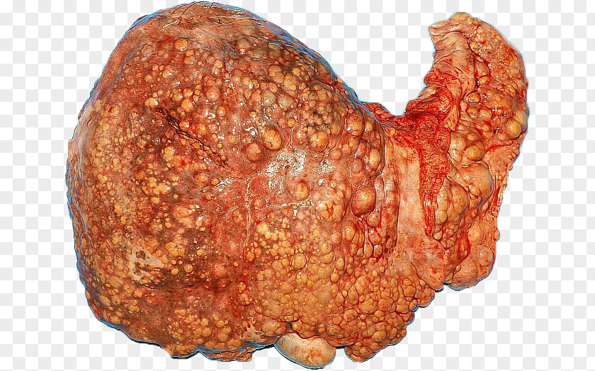 Liver Cirrhosis Alcoholic Drink Hepatitis C PNG
