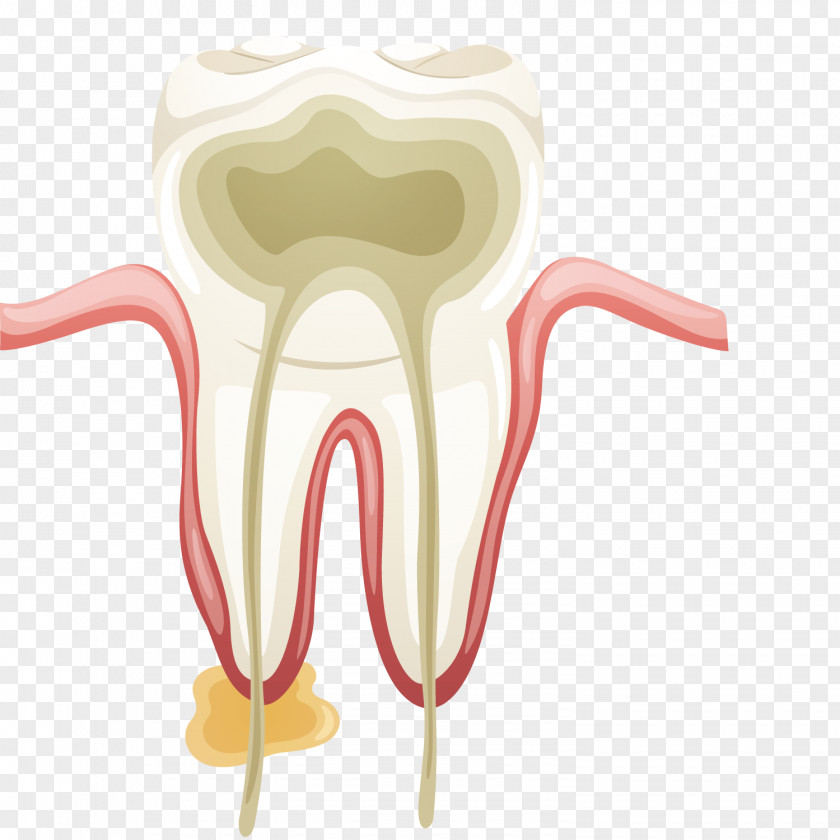 Vector Art Treats Teeth Dentistry Root Canal Tooth Endodontics Endodontic Therapy PNG