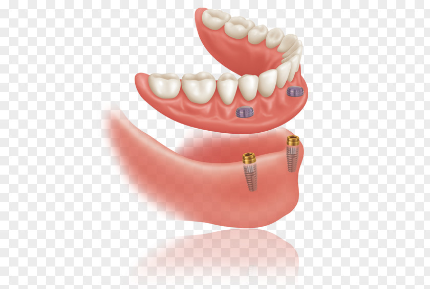 Bridge Dentures Dental Implant Bars Dentistry PNG