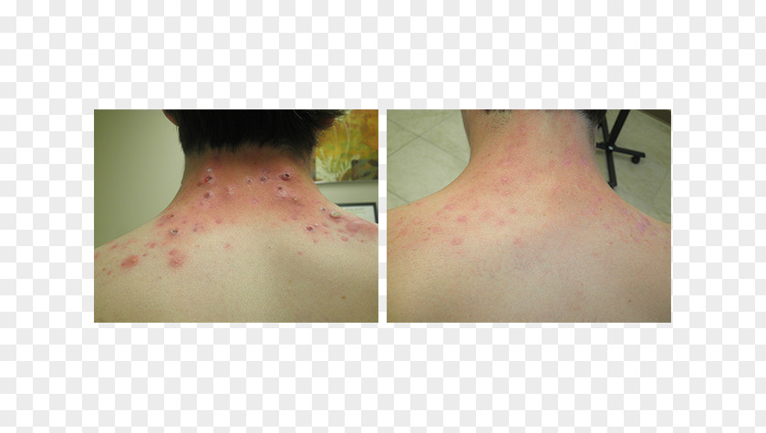 Month Of Fasting Isotretinoin Acne Scar Human Back Surgery PNG