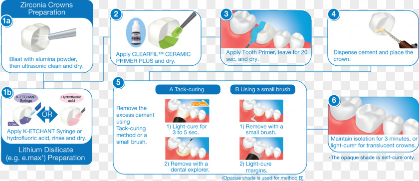 Zircon Cementum Dental Composite Inlays And Onlays Veneer PNG