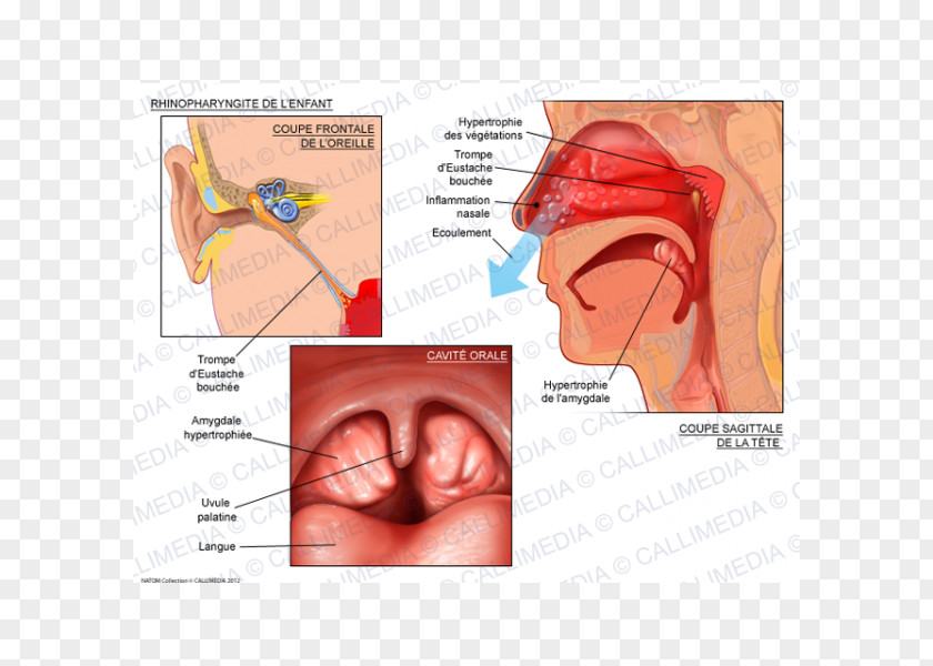 360 Degrees Tonsillitis Pharyngitis Infection Otorhinolaryngology PNG