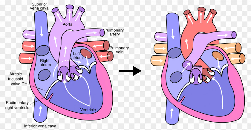 Neonatal Fontan Procedure Heart Surgery Tricuspid Atresia Pulmonary Artery PNG