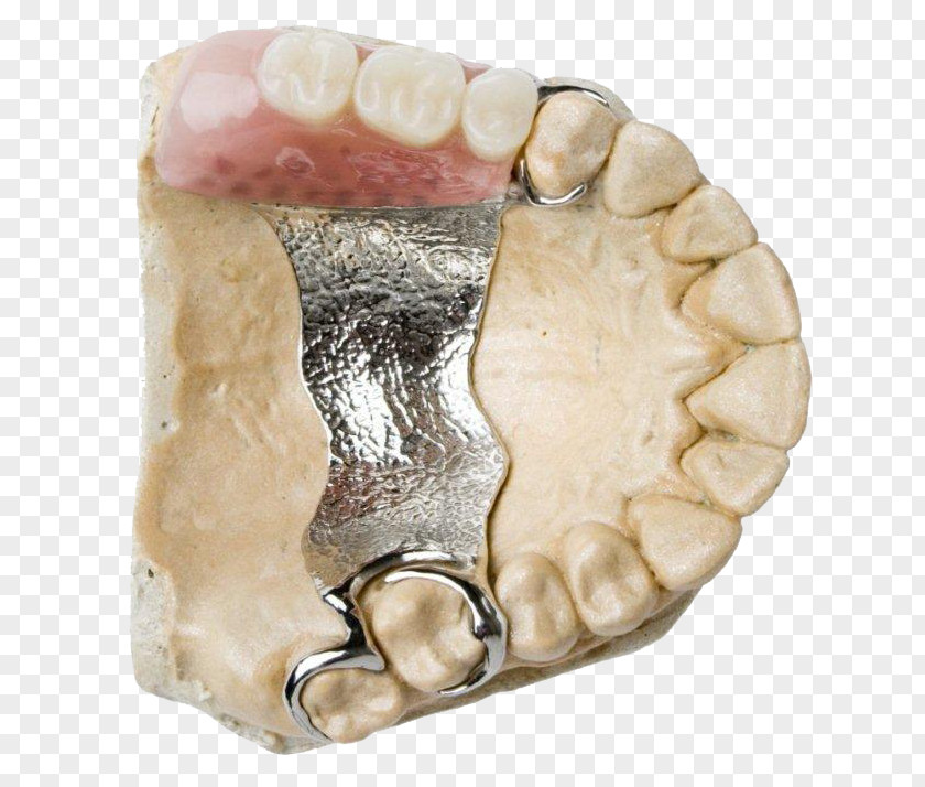 Scaling And Root Planing Dental Prosthesis Dentistry Dentures Prosthodontics PNG