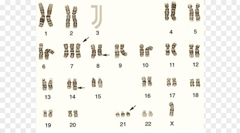 Dani Alves Trisomy Karyotype Nondisjunction Chromosome 21 Amyotrophic Lateral Sclerosis PNG