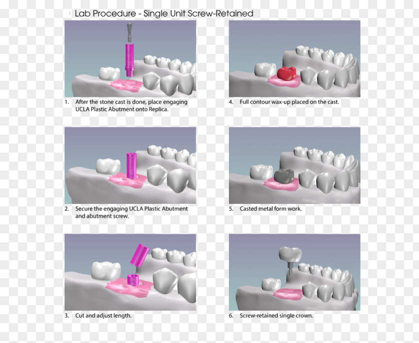 Dental Implants Abutment Implant Dentistry PNG