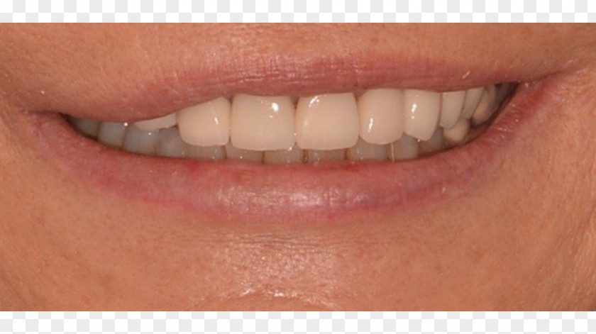 New Haven Prosthodontics, P.C. Human Tooth Cosmetic DentistryOthers Dr. Francesco P. Maratta PNG