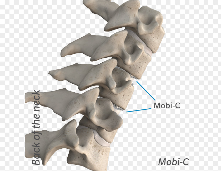 The Cervical Disc Surgery Anterior Discectomy And Fusion Vertebrae Intervertebral Arthroplasty PNG