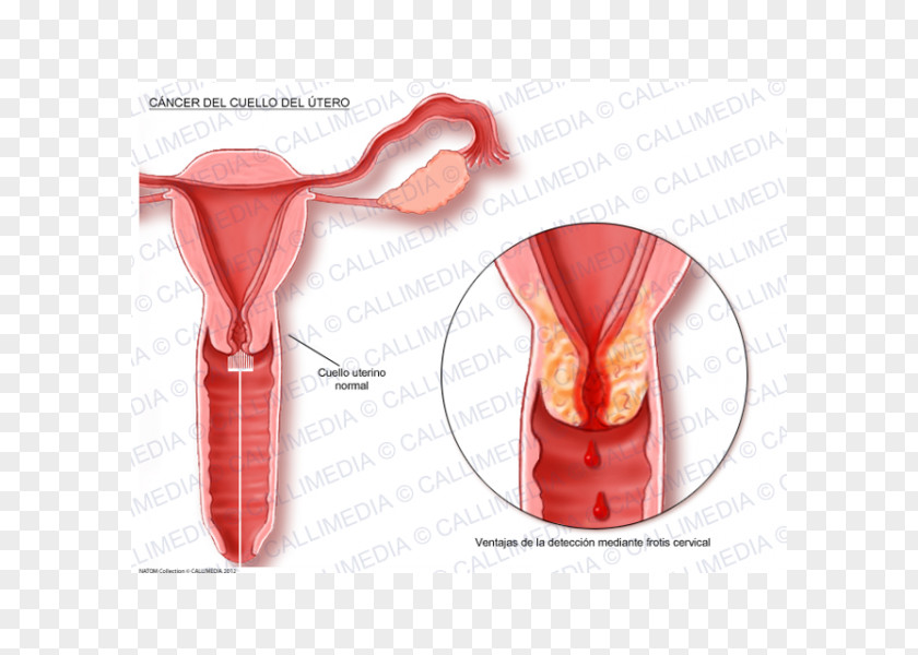 Utero Cervical Cancer Uterine Cervix Uterus PNG