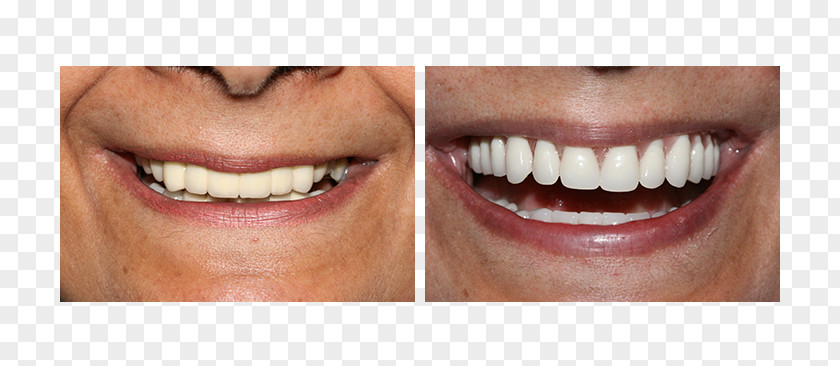 Tooth Surgery All-on-4 Dental Implant Dentures PNG