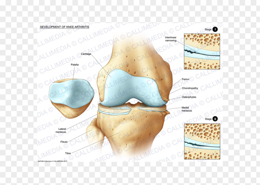 Artrosis De Rodilla Human Anatomy Knee Body Tibia PNG
