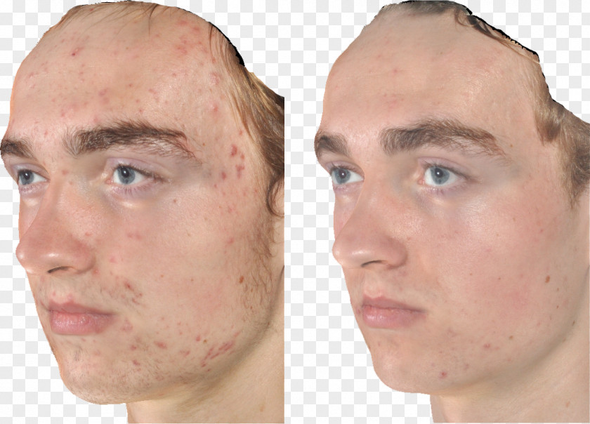 Benzoyl Peroxide Acne Cheek Group Skin PNG