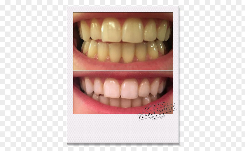 Tooth Whitening Dentistry Human PNG