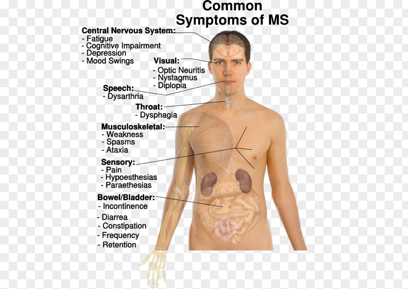 M And Ms Multiple Sclerosis Signs Symptoms Medical Sign Disease PNG