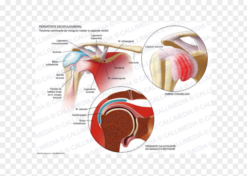Scapula Adhesive Capsulitis Of Shoulder Arthritis Periartrite Scapolo-omerale Rheumatology Ache PNG