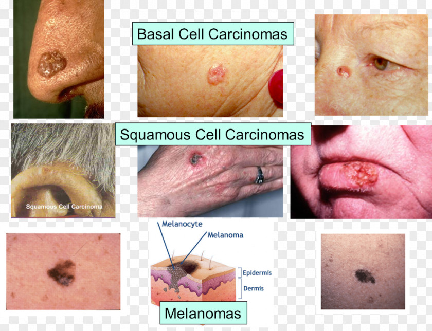Skin Cancer Melanoma Lymph Node PNG