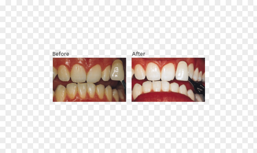 UreaPola Tooth Whitening Dentistry Hydrogen Peroxide PNG