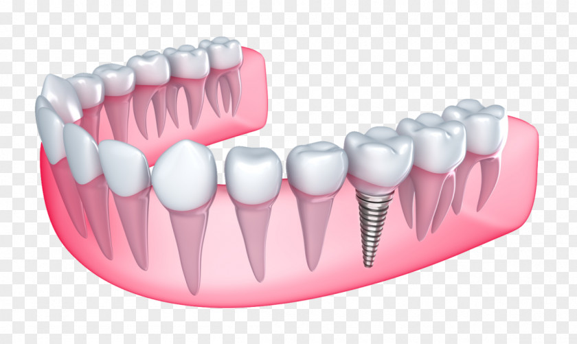 Bridge Dental Implant Dentistry Tooth Loss PNG